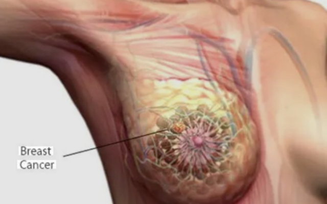 Breast cancer screening must be a priority, says TUC