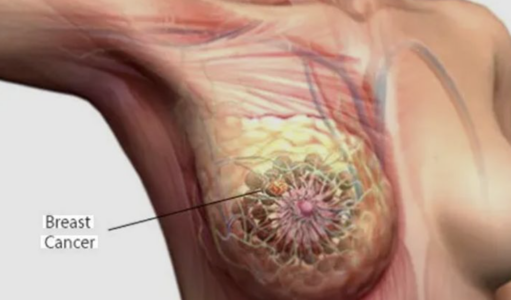 Breast cancer screening must be a priority, says TUC