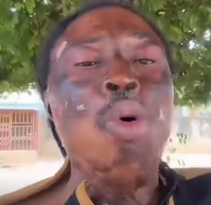 Nana Kwaku Bonsam appeals to Mahama, Ablakwa for help to faciliate his US travel for skin graft