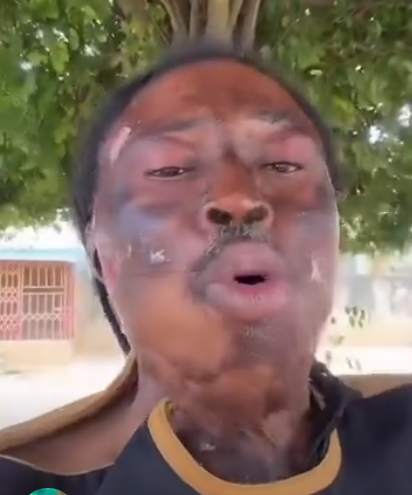 Nana Kwaku Bonsam appeals to Mahama, Ablakwa for help to faciliate his US travel for skin graft